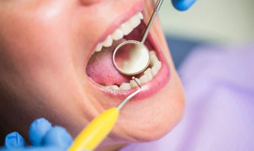 Featured image for “12 Benefits of Composite Fillings for Teeth”