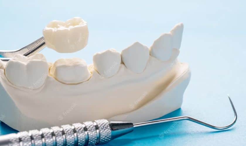 Featured image for “How Does A Dental Crown Enhance Your Smile?”