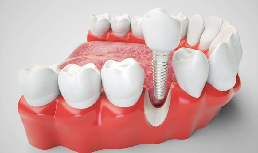 Featured image for “How To Have Successful Dental Implant Recovery?”