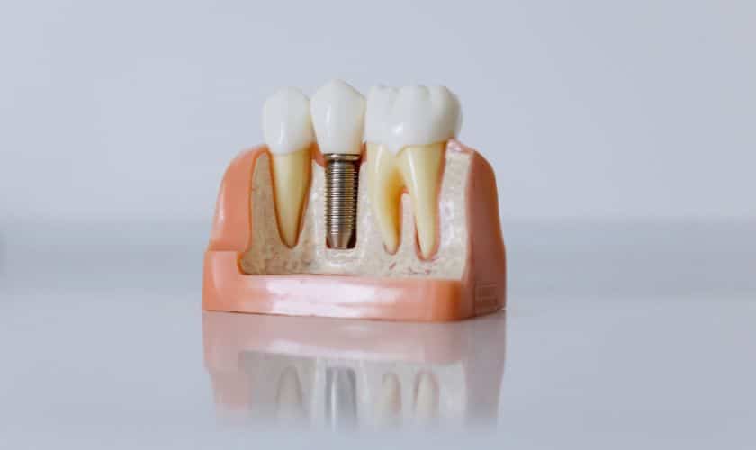 Featured image for “How To Care After Dental Implants?”