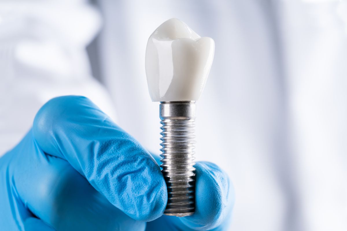 Featured image for “What is The Best Time for Dental Implants?”