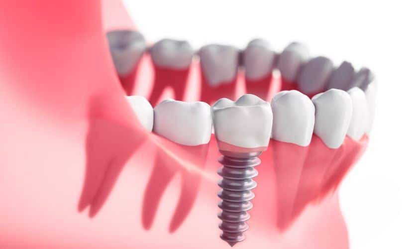Featured image for “Can Dental Implants Replace Multiple Teeth?”