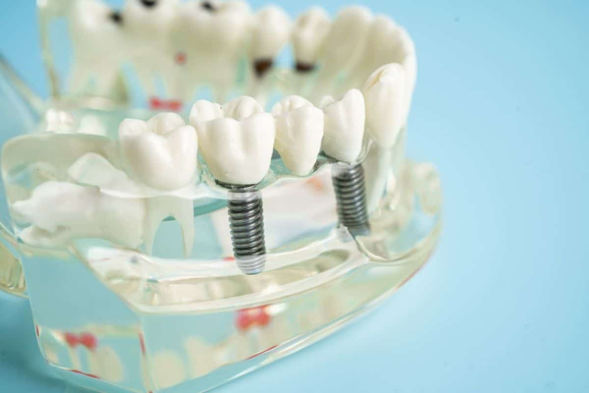 Featured image for “How Dental Implants Can Improve Your Oral Health?”