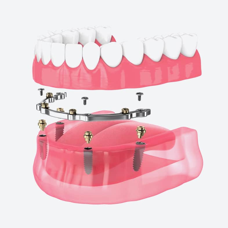 Dental implant prosthesis diagram showing titanium implants in jawbone with attachment bridge and ceramic teeth.