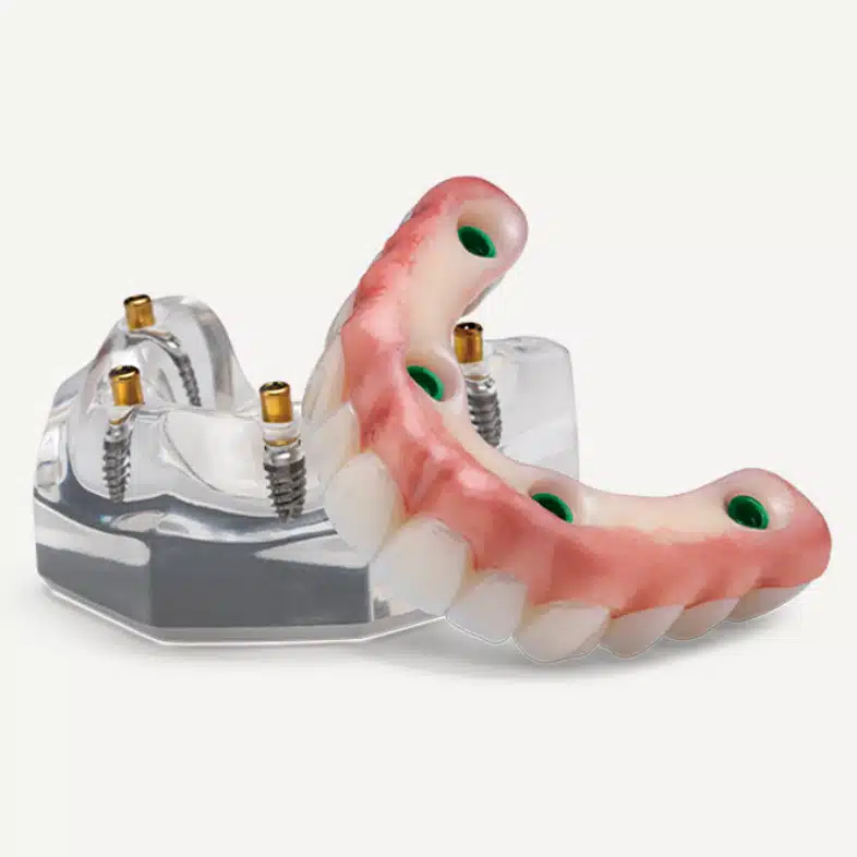 Dental implant model showing prosthetic teeth attached to titanium screws and surgical guide.