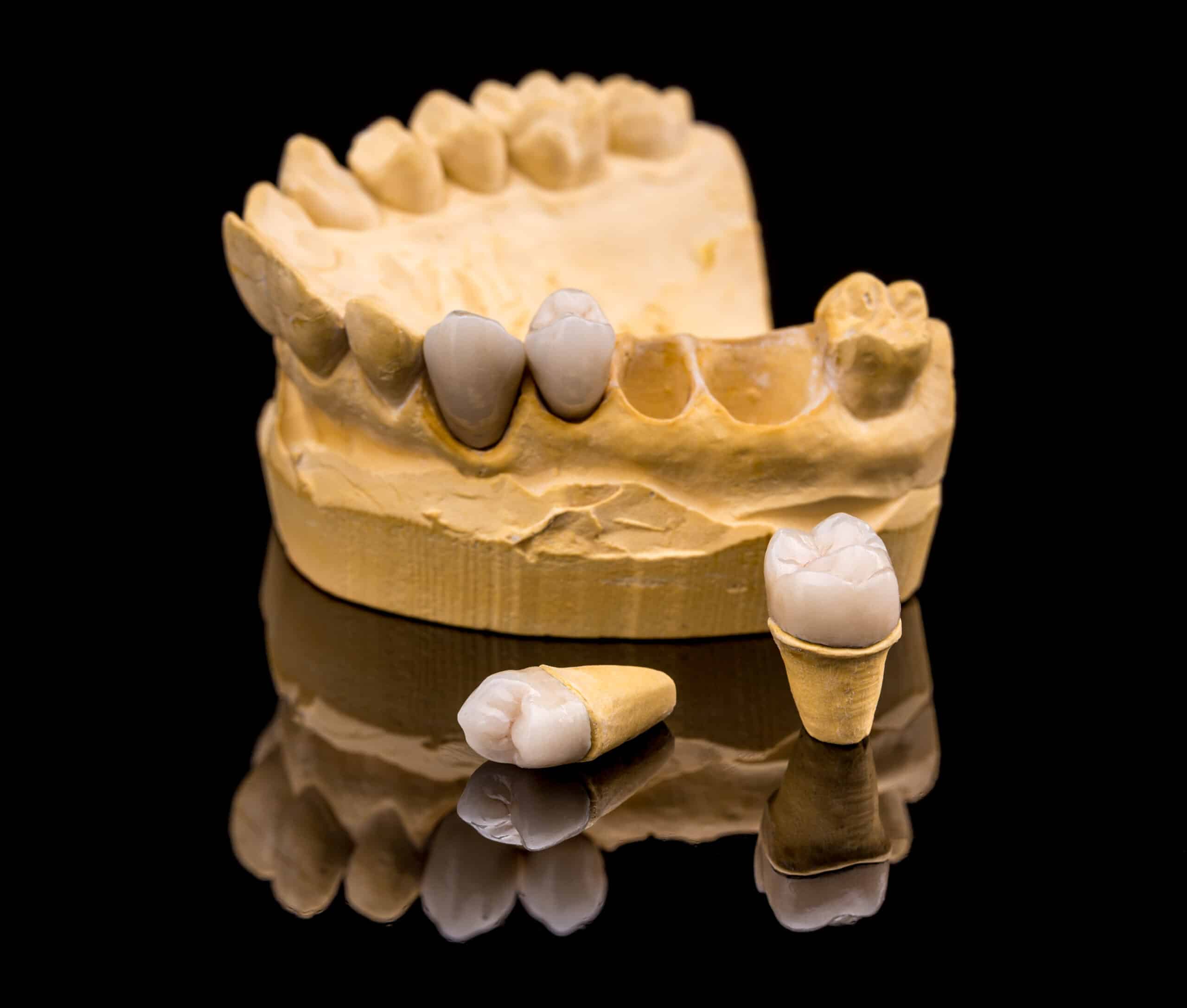 Featured image for “Is Replacing a New Dental Crown Painful? A Complete Dentist Guide”