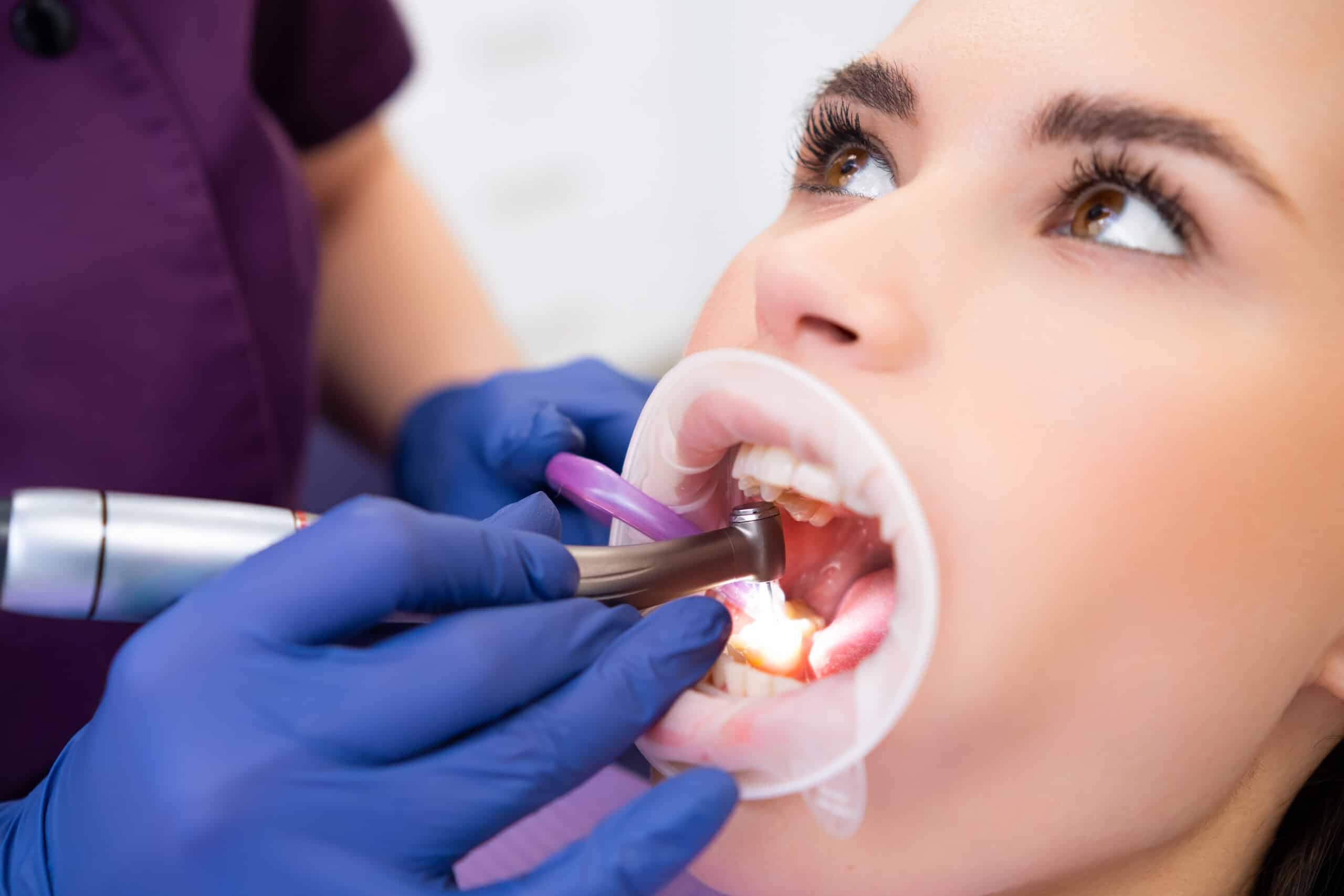 Featured image for “Why Do Composite Fillings Fall Out Easily?”