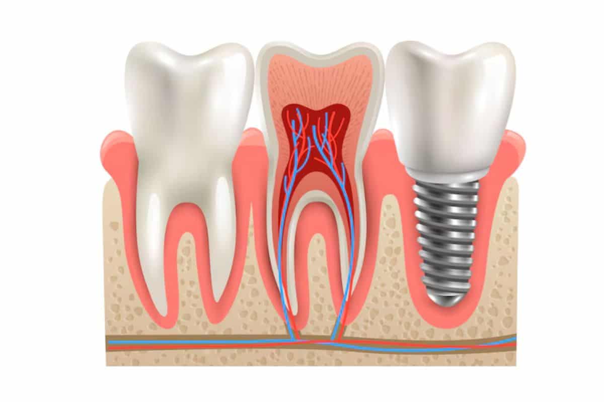 Featured image for “Dental Implants: A Complete Guide to Before and After Care”