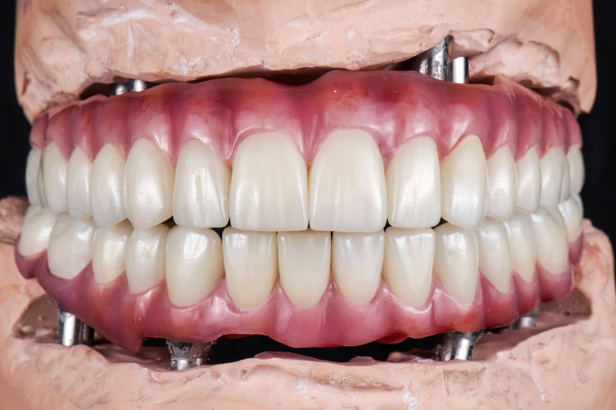 All On 4 Dental Implants Vs Dentures Dentist Syracuse