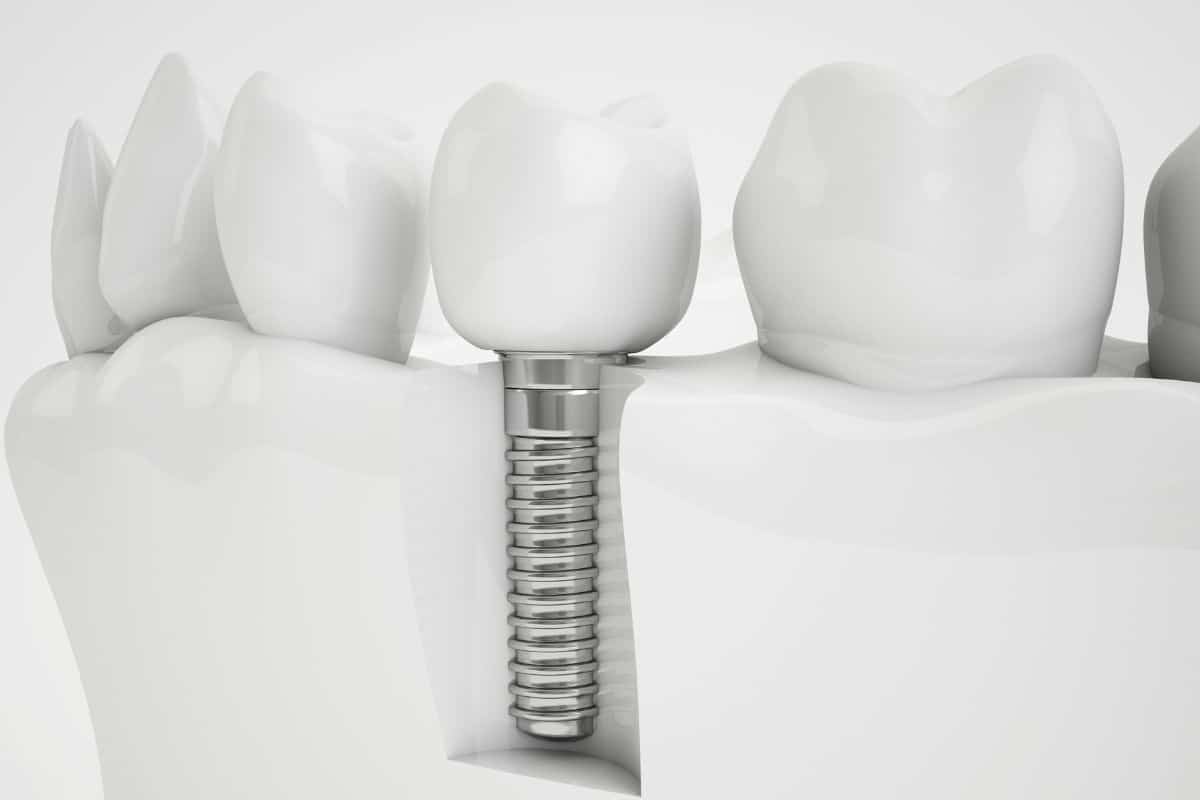 Featured image for “How Often Do Dental Implants Need to Be Replaced?”