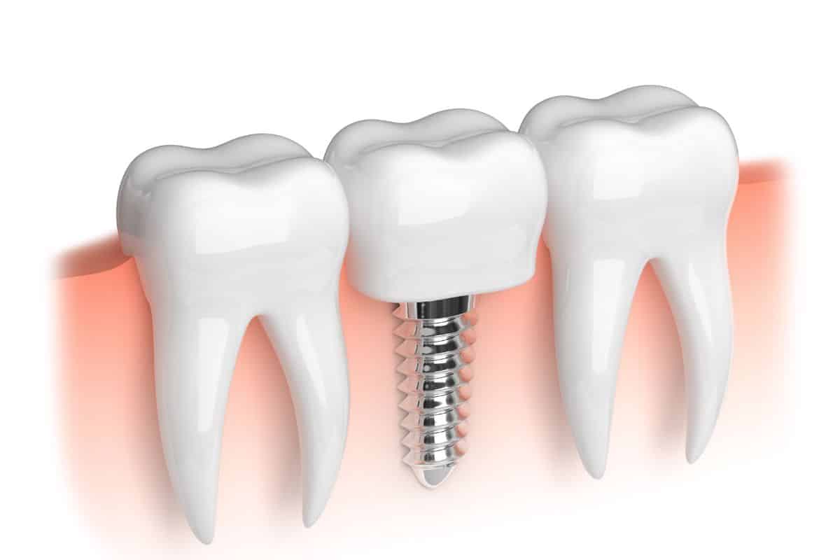 Featured image for “Why is Bone Grafting Crucial for Dental Implant Success?”