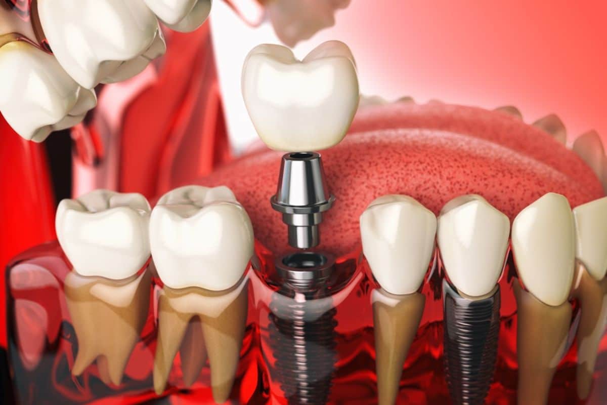Featured image for “Do Gums Grow Over Dental Implants?”