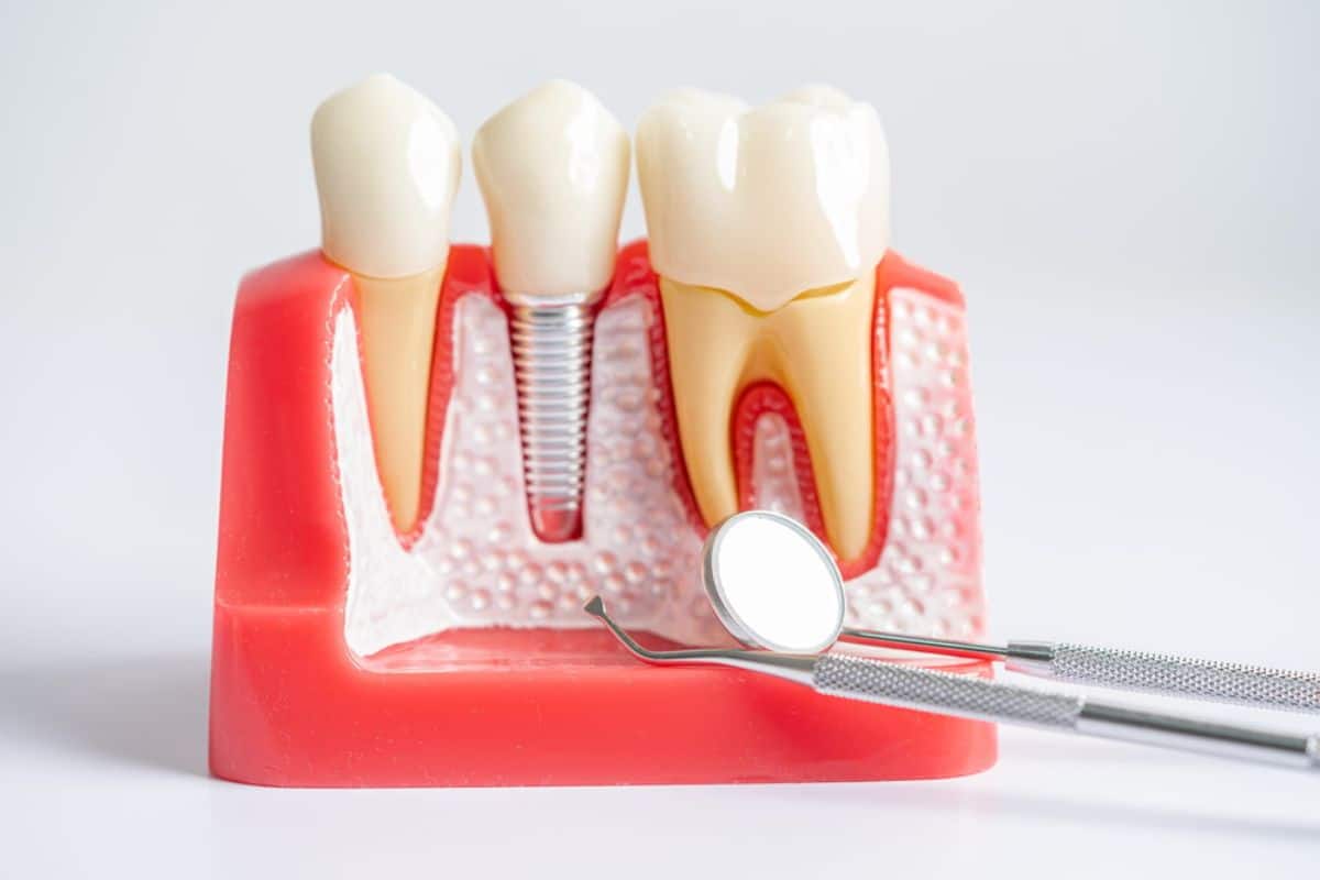 Featured image for “Can You Get Dental Implants If You Have Gum Disease?”