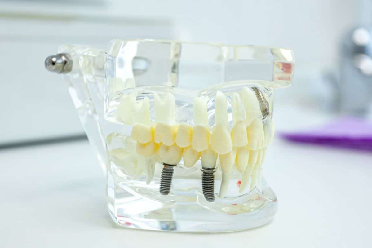 Featured image for “Is it possible to get a dental implant for a front tooth?”