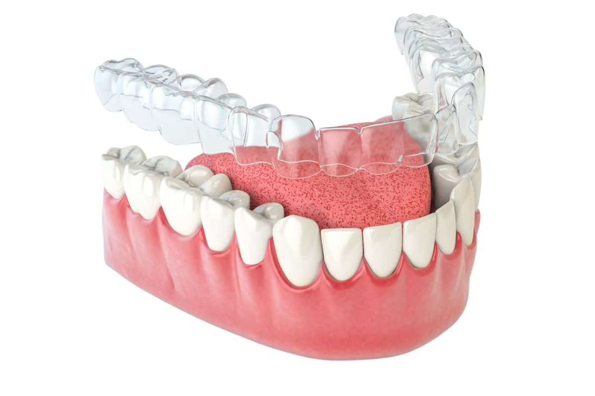 Featured image for “Understanding the Link Between Invisalign and Gum Recession”