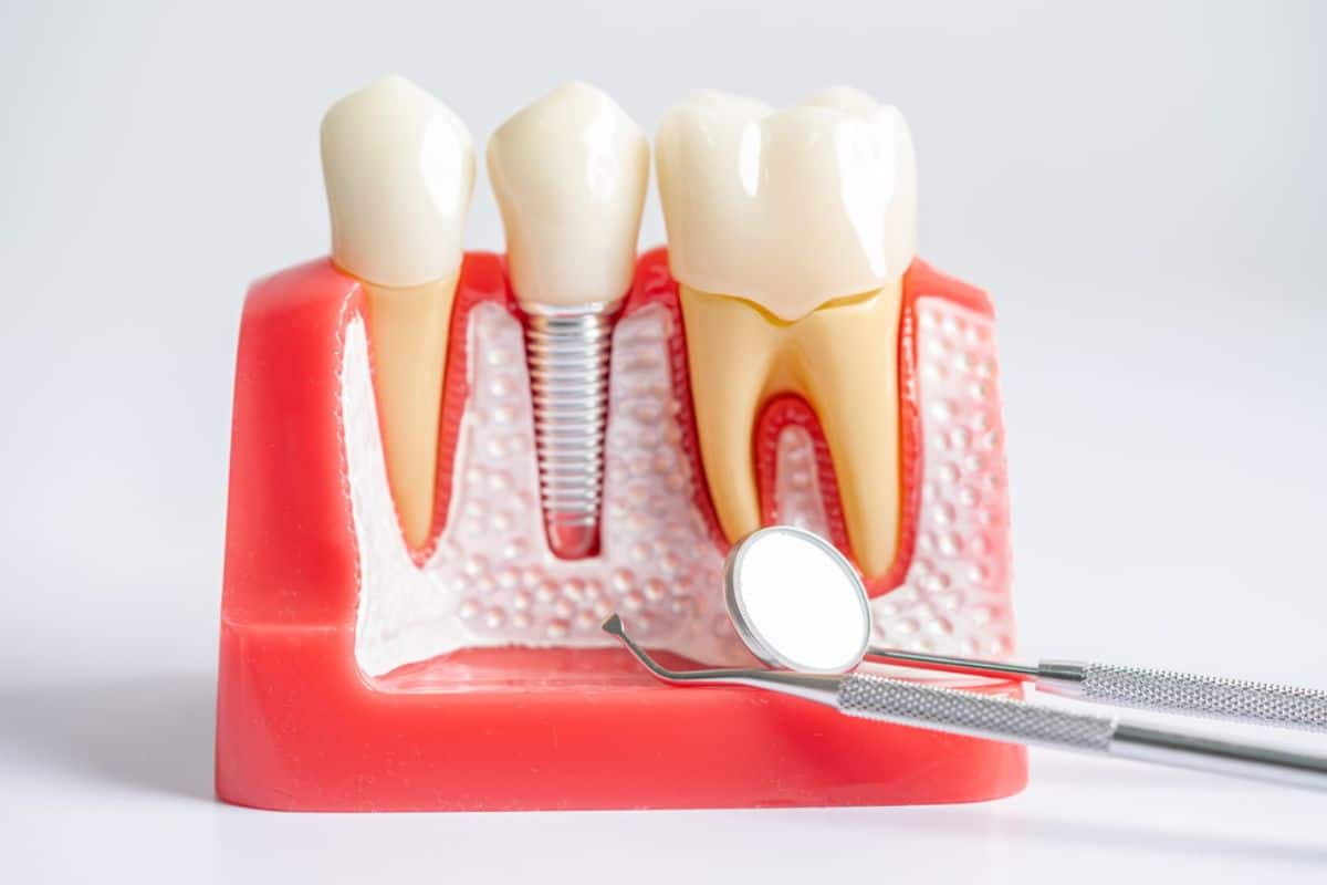 Featured image for “What to Do When a Dental Implant Comes Loose?”