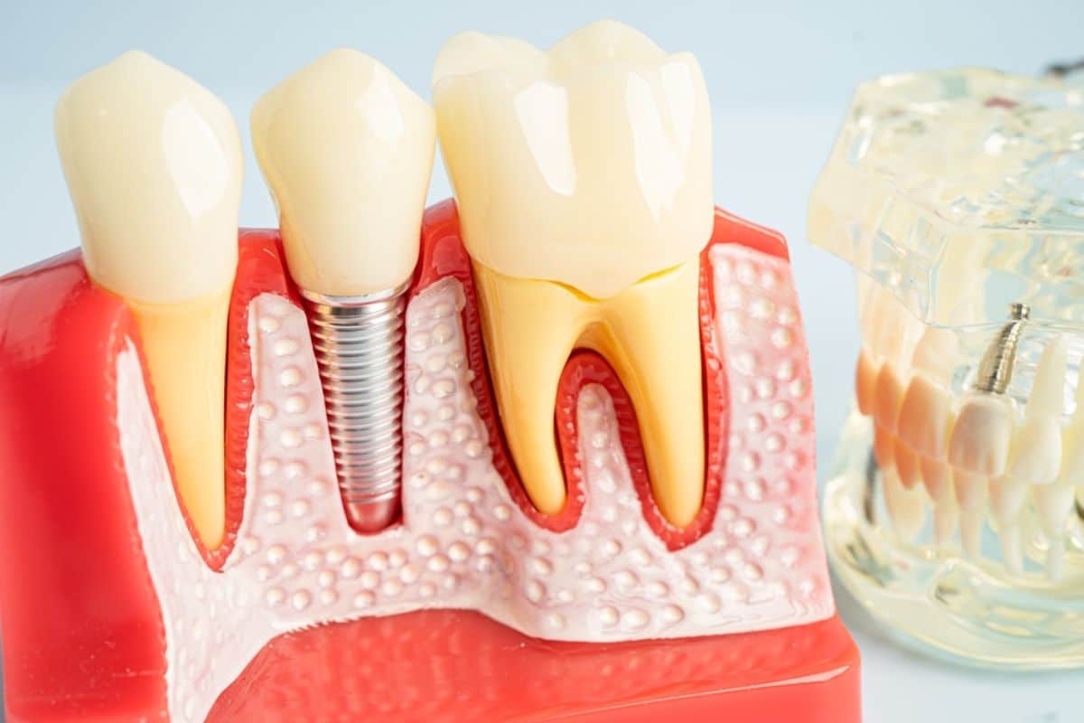Featured image for “How Long Should You Wait to Brush After Dental Implant Surgery?”