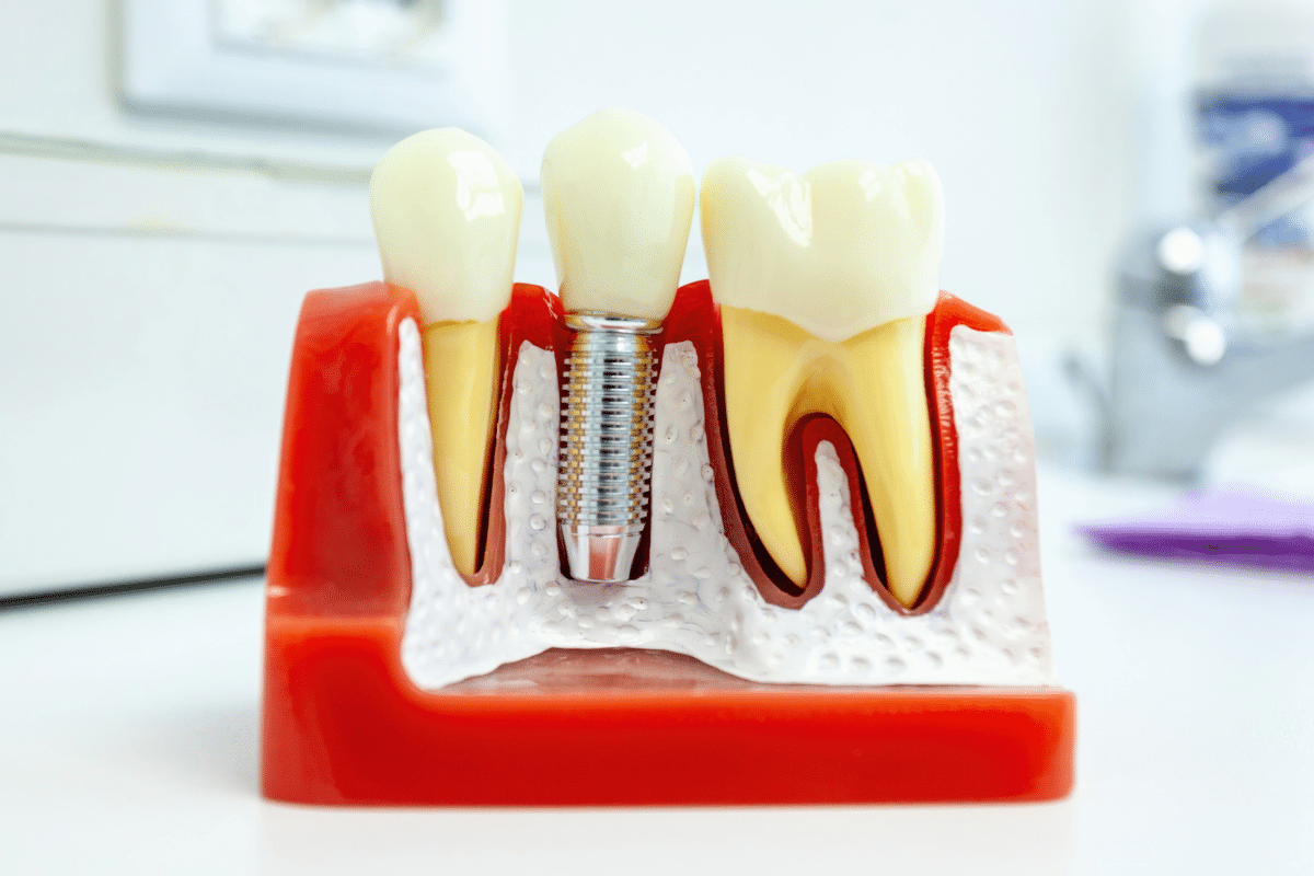 Featured image for “What to Eat After Dental Implant Surgery (And What to Avoid)”