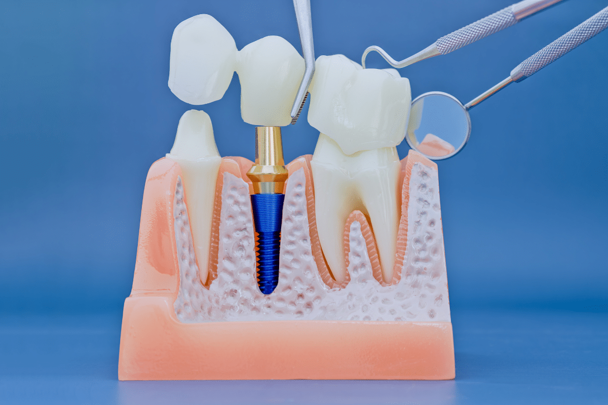Featured image for “Full Mouth Dental Implants: The Ultimate Smile Restoration”