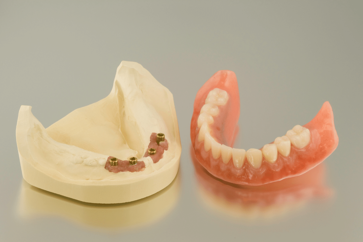 Featured image for “Implant-Supported Dentures: Freedom From Removable Plates”