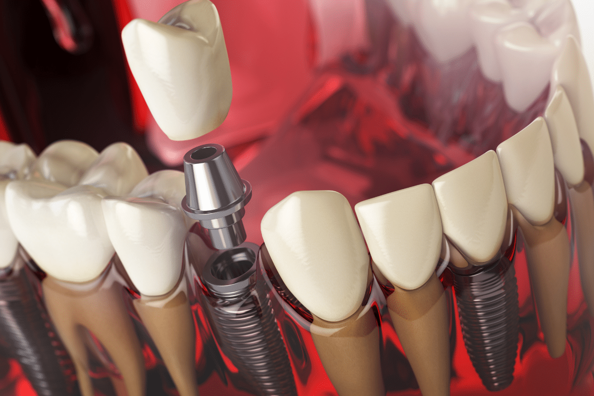 Featured image for “5 Ways To Prepare For Dental Implant Surgery”