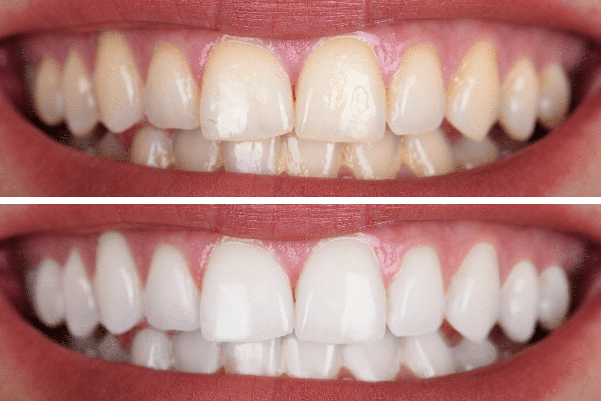 Featured image for “How Does Professional Teeth Whitening Improve a Dull or Yellow Smile?”
